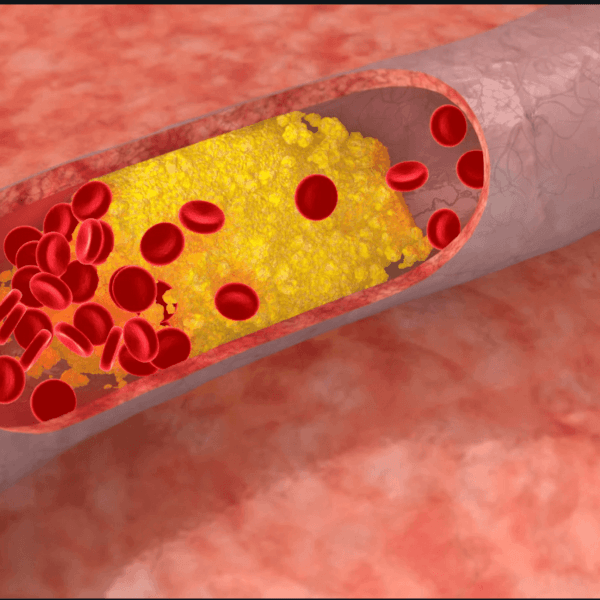 Bad Cholesterol Prevention Tips