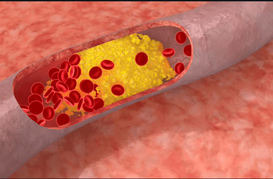 Bad Cholesterol Prevention Tips